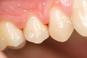 小絹駅・絹の台歯科クリニック・骨・歯周組織の再生治療に対応