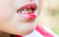 小絹駅・絹の台歯科クリニック・お口周りのケガ(外傷)の治療